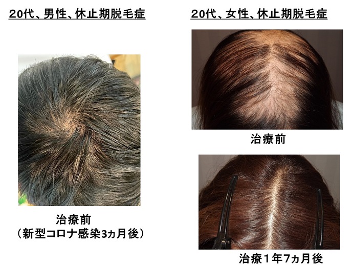 円形脱毛症　病院